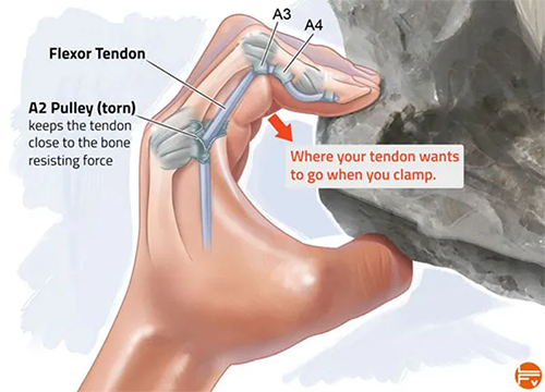 Climbing-Specific Body Tension - The Climbing Doctor